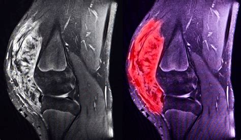 Musculoskeletal Expertise for Sarcoma Treatment - Vanderbilt Discover