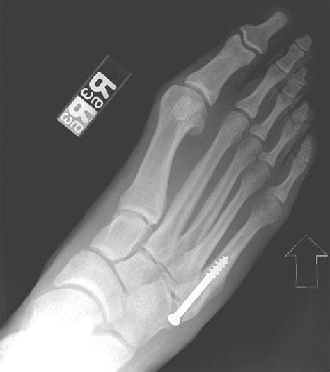 Failed Intramedullary Screw Fixation of a Proximal Fifth Metatarsal Fracture (Jones Fracture) in ...