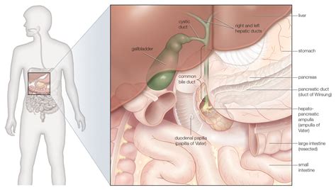 Understanding Gallstones and Gallbladder Disease