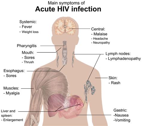 Acute retroviral syndrome causes, symptoms, diagnosis & treatment