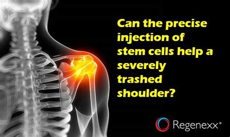 can treat severe shoulder arthritis injection | Shoulder arthritis, Arthritis, Severe