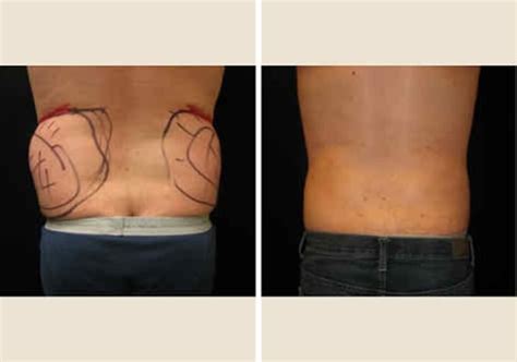 ATLANTA LIPOSUCTION SPECIALTY CLINIC - Updated November 2024 - 36 Photos & 17 Reviews - 6315 ...