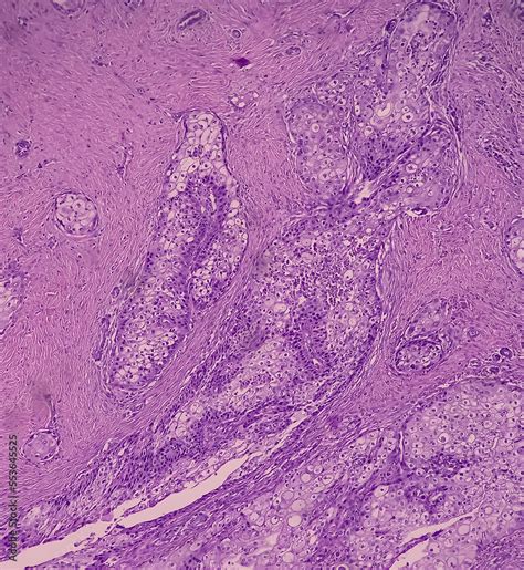 High grade mucoepidermoid carcinoma of parotid cyst. Microscopic show parotid tissue, features ...