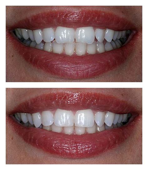 Tooth Contouring - Before & After | Bartholomew Dentist