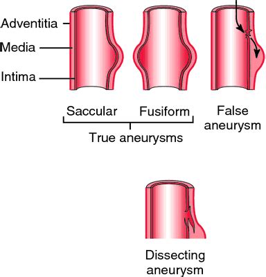 False aneurysm | definition of false aneurysm by Medical dictionary