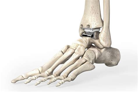 Ankle Replacement or Fusion? | Columbia Orthopedic Surgery