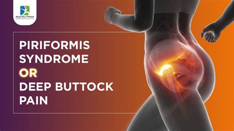 Piriformis Syndrome / Deep Buttock Pain, Diabetes care plan in Mumbai