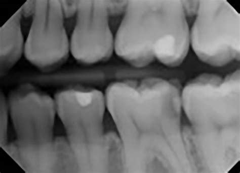 Dental x-rays | University of Michigan School of Dentistry