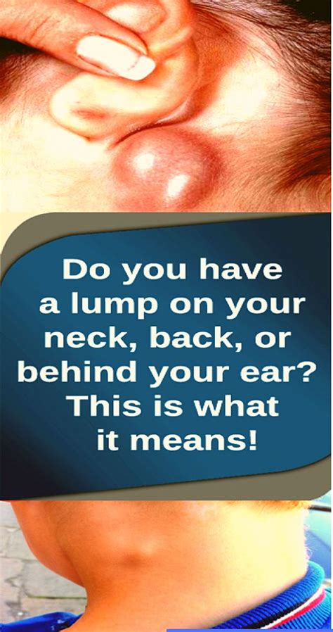 Do You Have a Lump on Your Neck,Back,or Behind Your Ear This Is What It ...