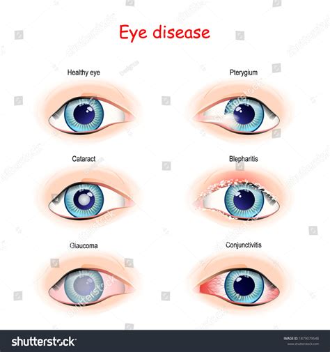 Diseases Of The Eye