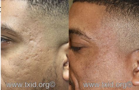 Do You Have Anything to Get Rid of Acne Scarring on African A merican and Dark Skin? (Valerie G ...