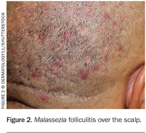 Folliculitis Scalp