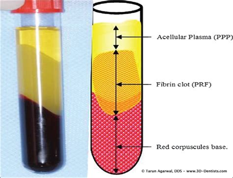 Platelet Rich Fibrin (PRF) – Your Next Journey in Implant Dentistry – 3D Dentists