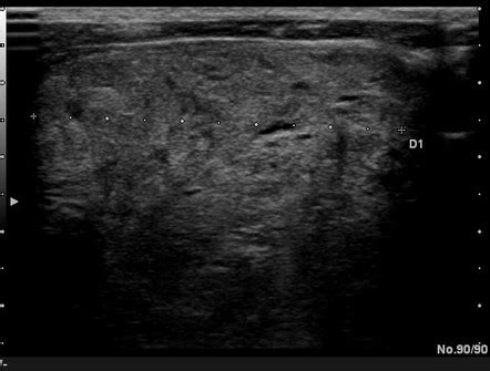 Multinodular goitre | Radiology Case | Radiopaedia.org