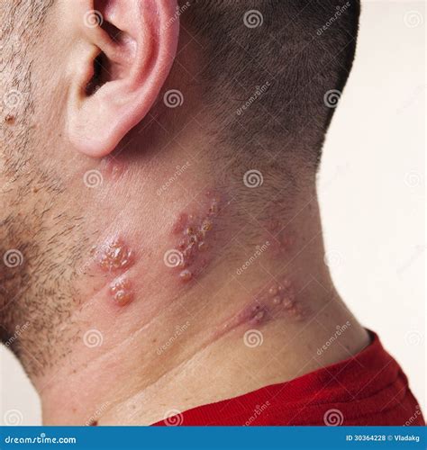 Raised Red Bumps And Blisters Caused By The Shingles Virus Royalty Free Stock Photos - Image ...