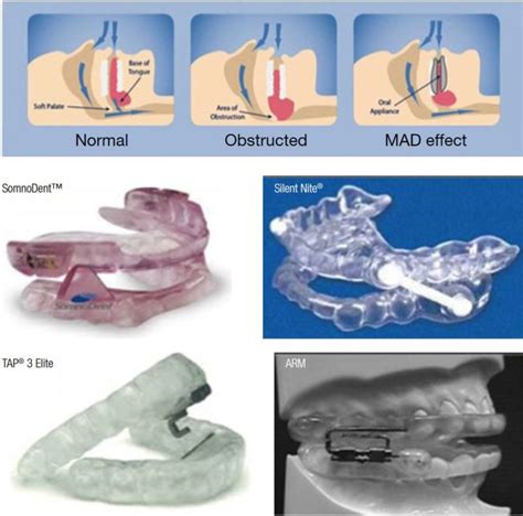 Orthodontic CE Article - A comparative review of mandibular advancement ...