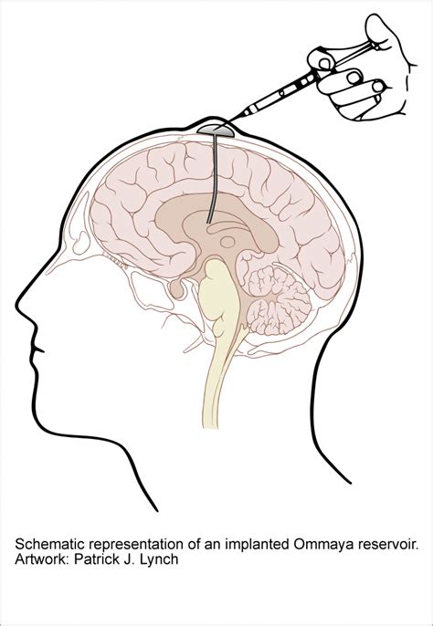 Ventricular Reservoir Placement | Adult Hydrocephalus Center