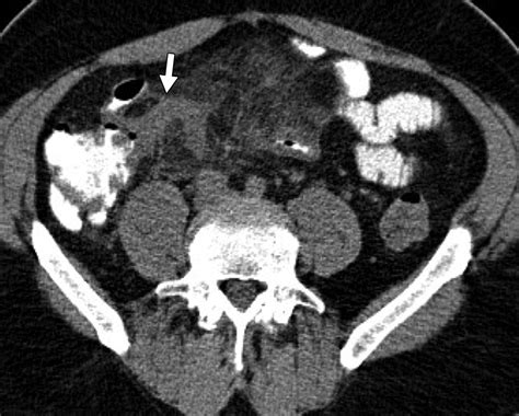 The “Misty Mesentery”: Mesenteric Panniculitis and Its Mimics | AJR