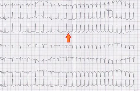 ECG Channel: AV Nodal Reentry Tachycardia