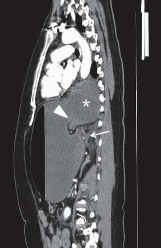 Gastric Volvulus | Radiology Key