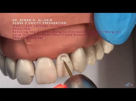 Class V cavity preparation (Large) for composite on a maxillary lateral incisor (#22) - Arabic ...