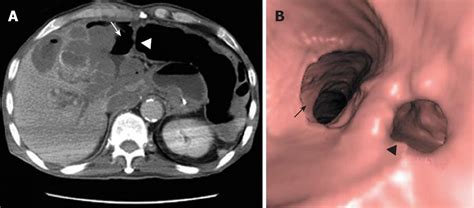 Perforation of the colon by invading recurrent gastrointestinal stromal tumors during sunitinib ...