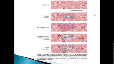 Tissue Repair by Scar formation - YouTube