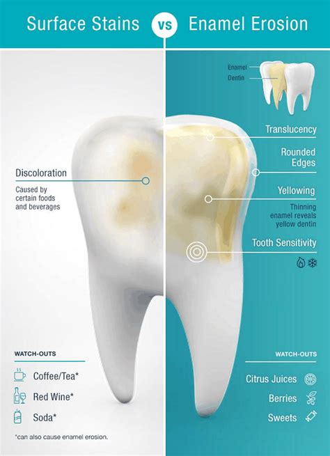 Tooth Enamel Loss: Symptoms & Remedies – Sabka Dentist – Top Dental Clinic Chain In India | Best ...