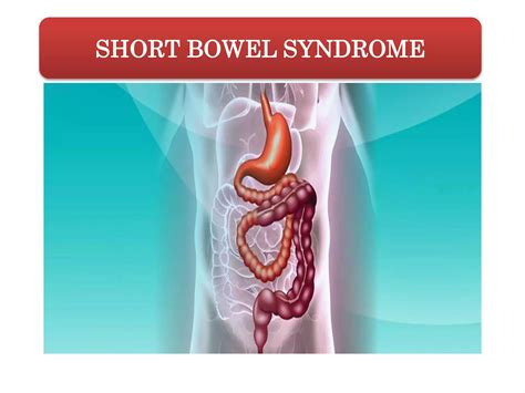 SHORT BOWEL SYNDROME | PPT