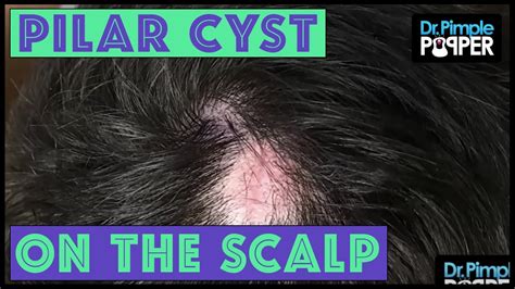 Multiple Pilar Cysts On Scalp : Pilar Cyst Of The Scalp Open I : I will ...