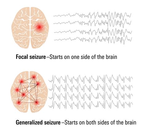 Types of Seizures