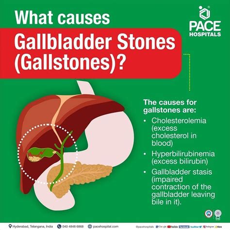 Gallstones, Gallbladder Stones – Symptoms, Causes, Complications