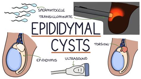 Understanding Epididymal Cysts - YouTube