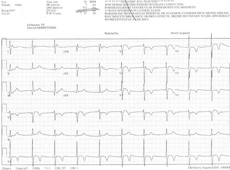 Pedi cardiology: EKG: Junctional Rhythm with Retrograde P waves...