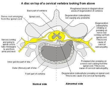 Cervical Radiculopathy - Physiopedia