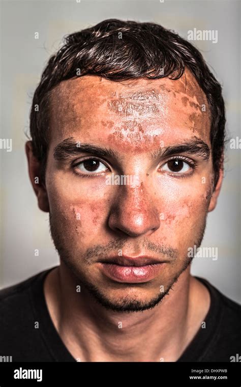 Sunburn skin peeling on male face caused by extended exposure on direct sun Stock Photo - Alamy