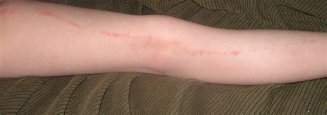 Red Itchy Bumps On Skin In Lines | Images and Photos finder