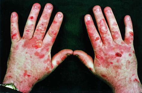 Porphyria cutaneous tarda causes, symptoms, diagnosis & treatment