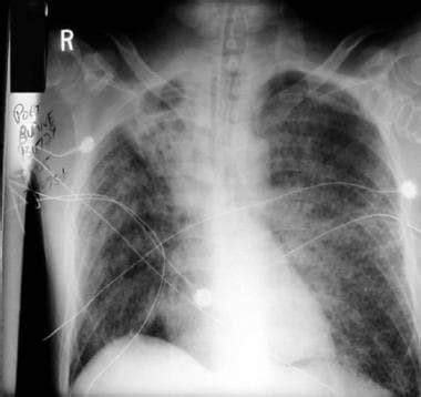 Pulmonary Blastomycosis Imaging: Practice Essentials, Radiography, Computed Tomography