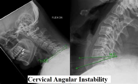 Cervical Instability - ShimSpine