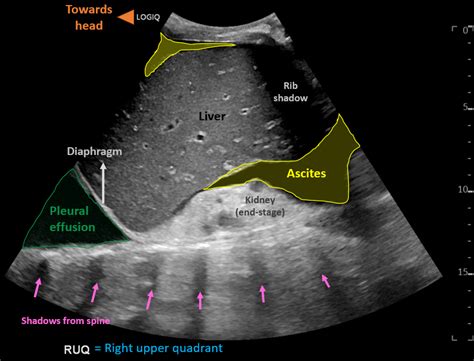 Ascites Vs Pleural Effusion Ultrasound 9424 | The Best Porn Website