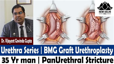 Buccal Mucosal Graft (BMG) Urethroplasty - YouTube