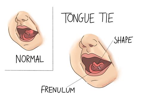 Tongue Tie