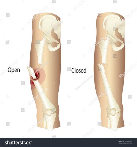 4,432 Open Fracture Images, Stock Photos & Vectors | Shutterstock