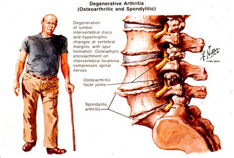 Arthritis of The Spine | Arthritis In Back Symptoms