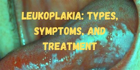 Leukoplakia: Types, Symptoms, and Treatment - Nursing Exam Paper