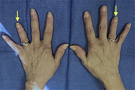 Brachydactyly - observation | Hand Surgery Source