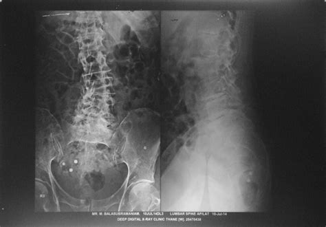 Phleboliths in the pelvis | X-Ray LS Spine with spondylosis … | Flickr