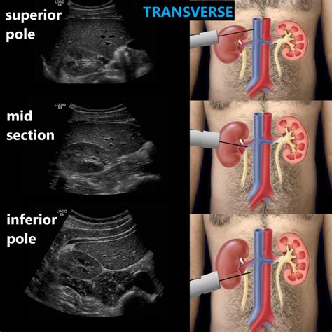 Kidney Anatomy Ultrasound