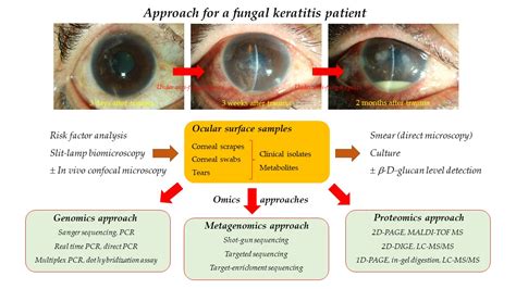 Fungal Corneal Ulcer Satellite Lesion